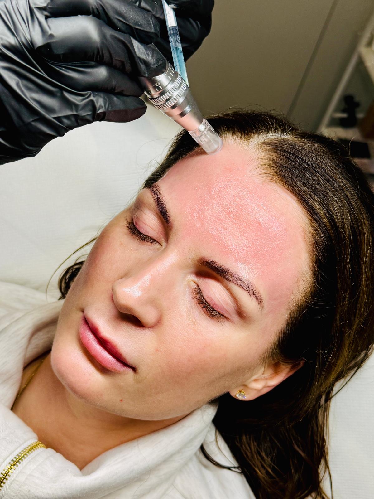 Microneedling with the Axion device and LED light therapy